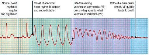 Showing various rhythms before cardiac arrest