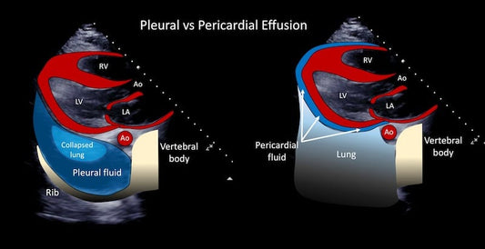 Plural & Pericardial Effusion | What are they?